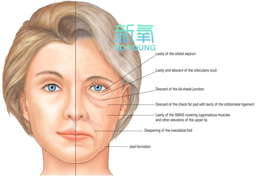 随之而来的就是颧脂垫下垂引发法令纹,颊脂垫松弛出现木偶纹,嘴角囊袋