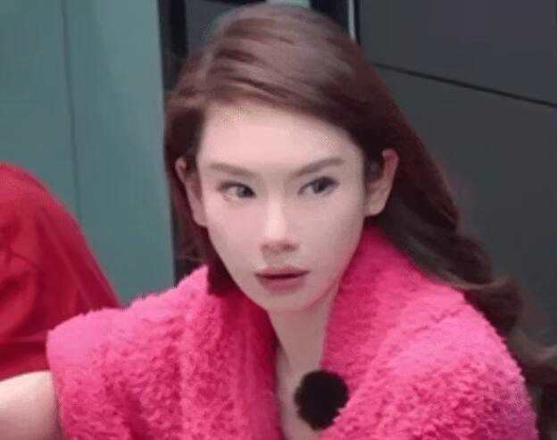 戚薇大方承认过度医美 称打肉毒打僵眉毛