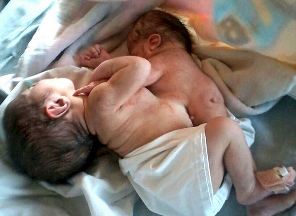 印妇女产“寄生双胞胎”共用肝脏血液