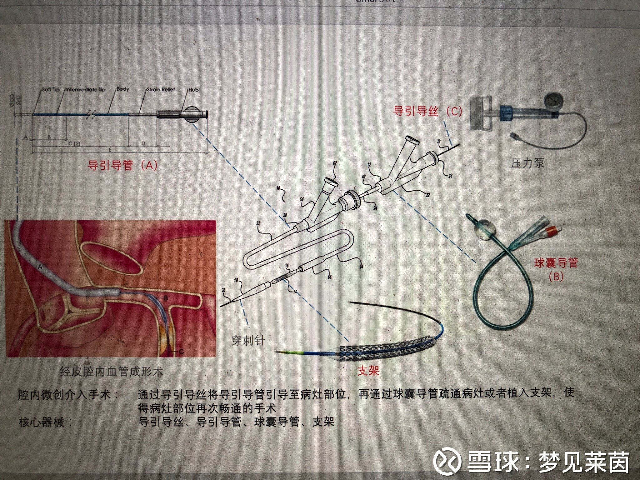 简单聊一下经皮冠状动脉介入治疗(pci)手术器械既