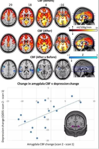 神奇蘑菇抑郁癥