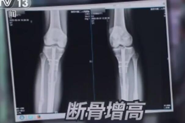 斷骨增高.jpg