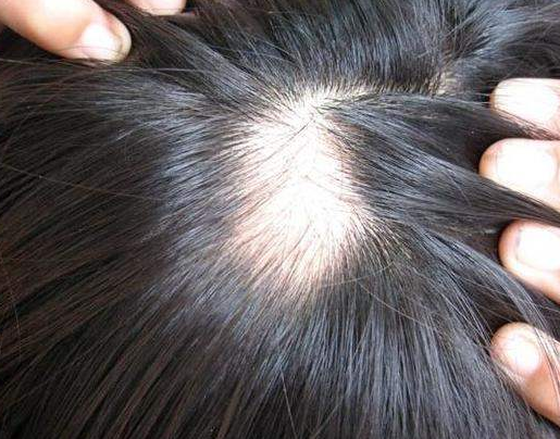 脫發(fā).png