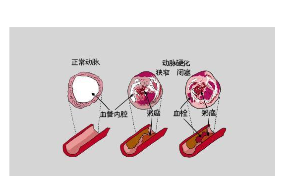 急性心梗的并發(fā)癥