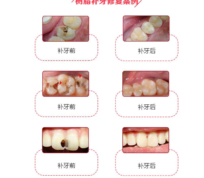 補牙可以用醫(yī)保嗎.png 補牙可以用醫(yī)保嗎.png