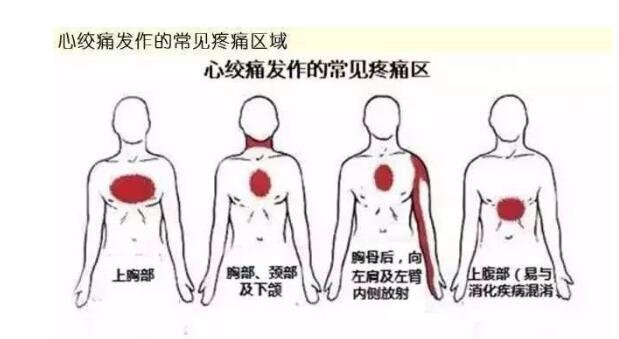 心梗的症状有什么表现？有心梗的要饮食要注意些什么？